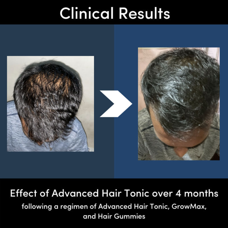 Buy Redensyl Procapil Hair Growth Tonic (60ml) Man Matters